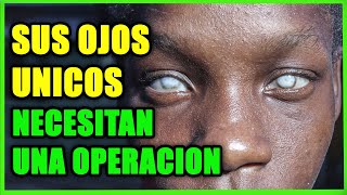 Probablemente Estos Sean Los Unicos Ojos En El Pais Y Necesitan Una Operacion