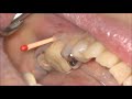 歯ぐきが腫れて痛い　根管治療の前にレントゲン撮影で原因を調べる　マイクロスコープ