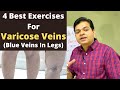 Varicose Veins Exercise, Blue Veins in Legs, Spider Veins Exercise, Varicose Veins Treatment At Home