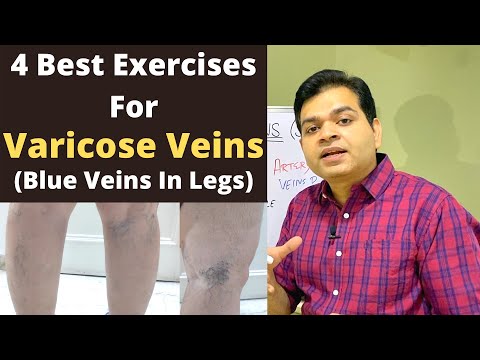 Varicose Veins Exercise, Blue Veins in Legs, Spider Veins Exercise, Varicose Veins Treatment At Home