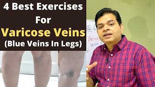 gel varicose mai bun varicoza venoasa