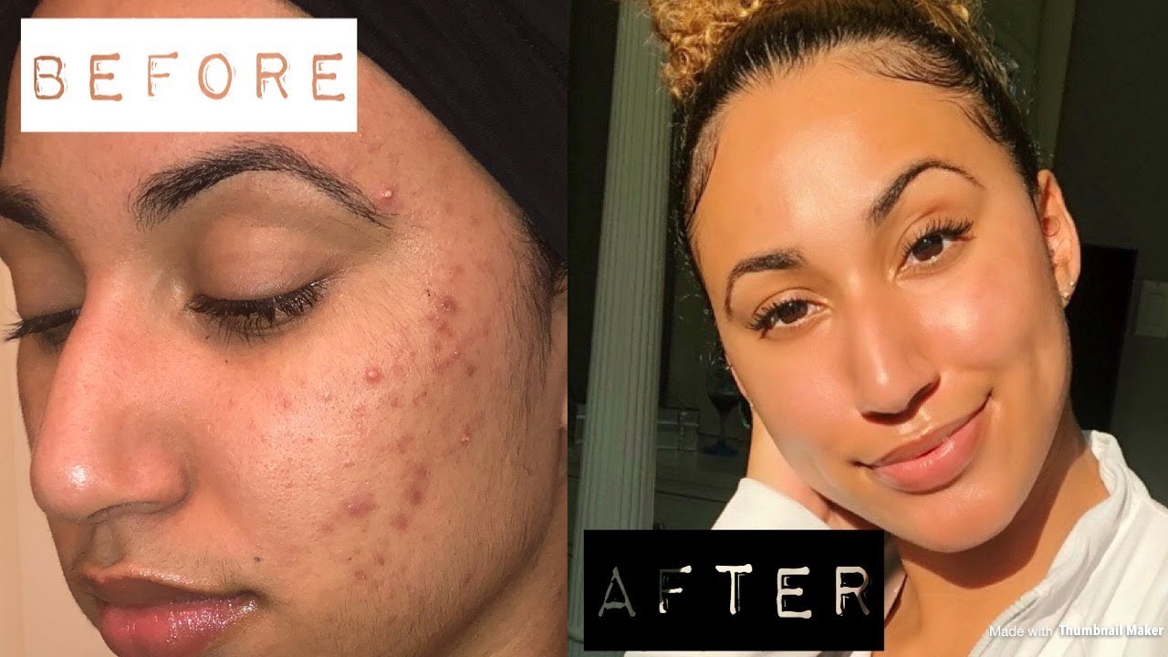 HOW I CLEARED MY ACNE WITH 1 PRODUCT (IT WORKS!) Night Time Skin Care Routine YouTube