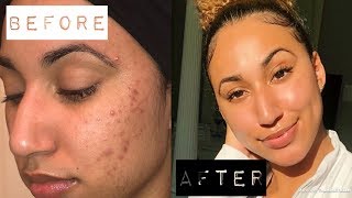 HOW I CLEARED MY ACNE WITH 1 PRODUCT (IT WORKS!) | Night Time Skin Care Routine