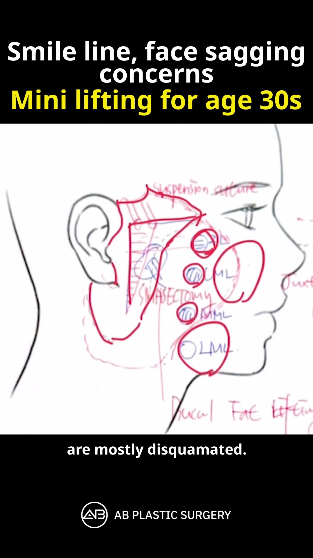 Embrace confidence and youthfulness after our rejuvenating facial lifting procedure.
