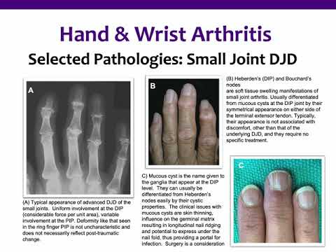 Hand and Wrist Arthritis - ABOS Orthopedic Surgery Board Exam Review
