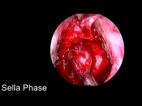 Endoscopic Endonasal Transsphenoidal Approach for Removal of Pituitary Macroadenoma