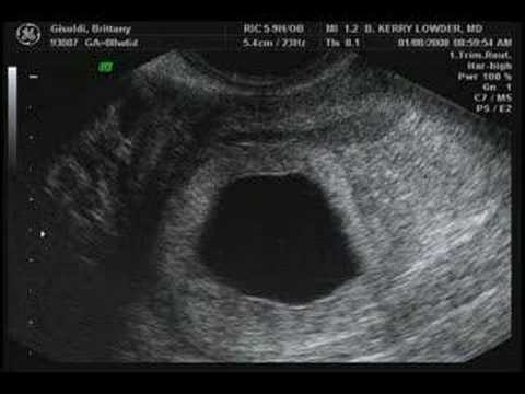 7 week sonogram pictures