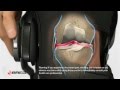 Learn About Knee Osteoarthritis (OA)