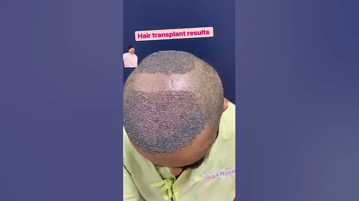 😱 Hair Transplantation Result Before And After ✅ #shorts - DayDayNews