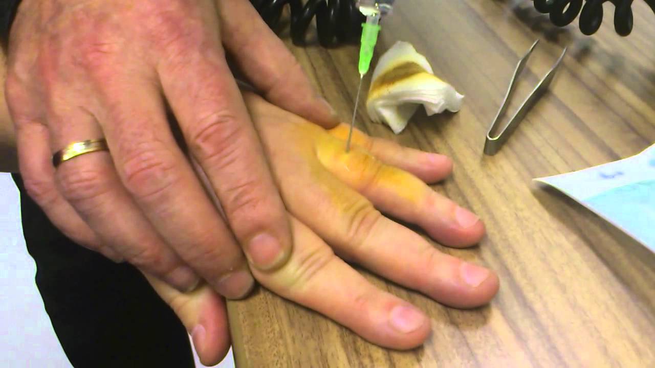 Splinter Onder Nagel Verwijderen Met Verdoving(Remove Splinter Under Nail  With Anesthetic) - Youtube