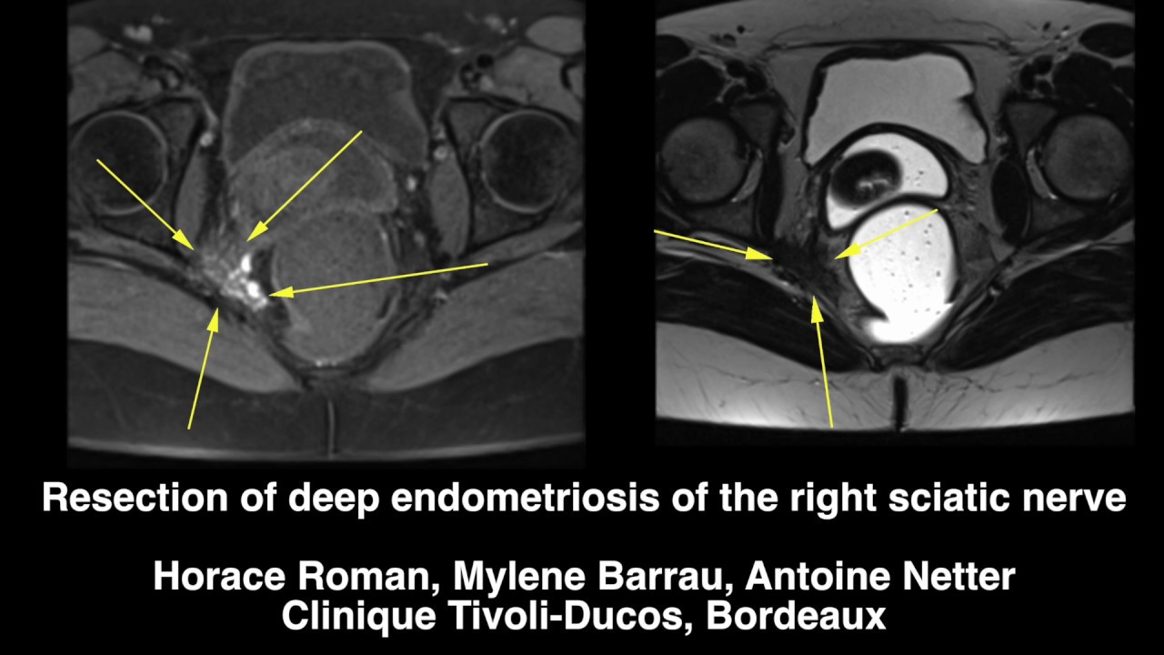 Deep endometriosis of sciatic nerve anatomy and resection YouTube