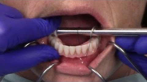 Removal Tool Bar and Prosthesis Removal Loop Technique for LOCATOR F-Tx