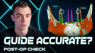 Did Your Surgical Guide Actually Work The Accuracy Test You Need