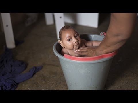 bayi dengan microcephaly, yang disebabkan oleh Virus Zika, bayi dengan kepala kecil dan otak.