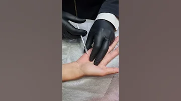علاج العرق الزائد فرط التعرق في اليدينHyperhydrosis In Palms Treated Using Botulinum Toxin Inject 