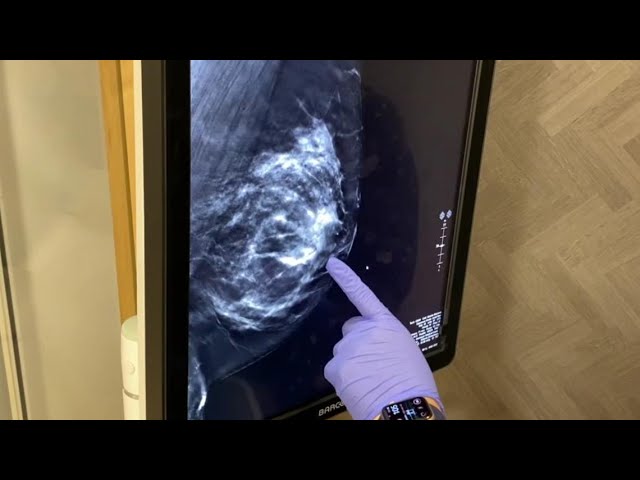 New guidelines for breast cancer screenings | Healthwatch 16