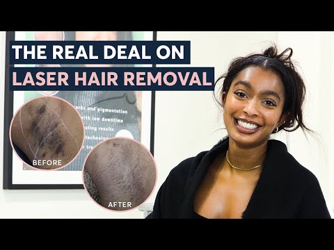 Getting Laser Hair Removal? Watch THIS First!