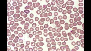 Babesia (RIFE Healing Frequency)