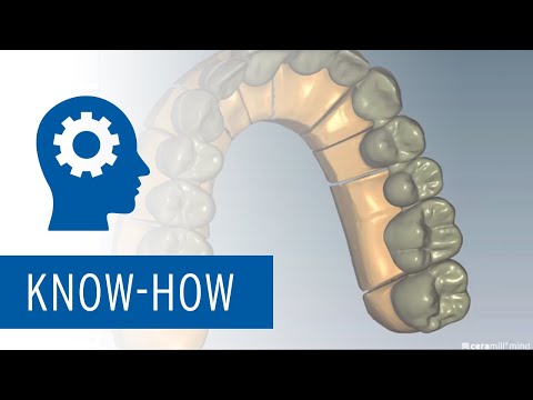 Ceramill Mind - Insertion of missing parts in a finished construction