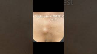 Download Lagu Surprise Steatocystomas MP3 Download Lagu Surprise Steatocystomas MP3
