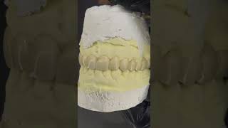#afghanistan #zirconia #duet #cadcam #dental #allahtraining #exocad #implant #nature #porcelain#job
