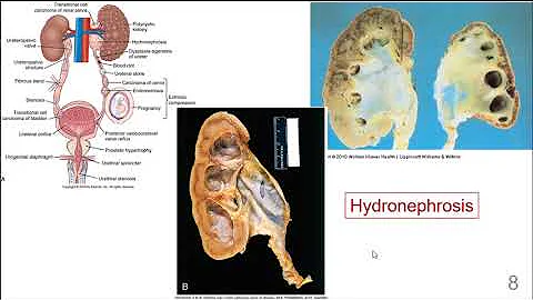 Renal and Urologic Disorders