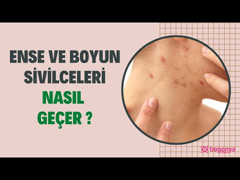 Ensede Çıkan Sivilceler Nasıl Geçer?