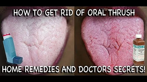How to Treat Candida at Home: Doctors Advice
