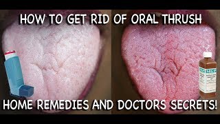 In this video we will discuss what is oral thrush and how we diagnose and manage it?. 
