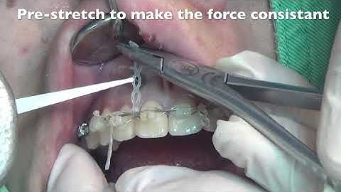 Insertion Torque and how to use the wrench to measure｜【Chris Chang Ortho】CC525