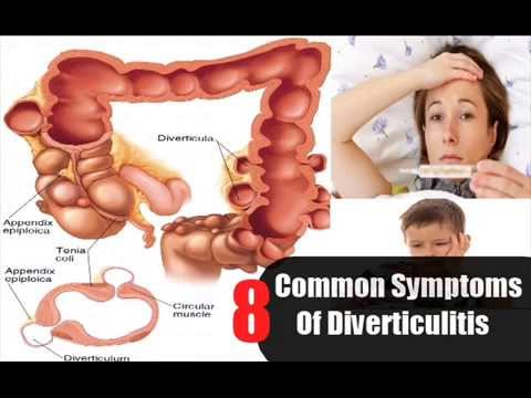 How To Treat Diverticulitis Naturally How To Treat Diverticulitis Naturally