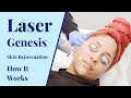 What is laser genesis  cosmetic treatments at byou laser clinic