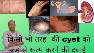 किसी भी तरह की गांठ को ठीक करने कि 2 होमीयोपैथी दवाई।l Homoeopathic medicine for cyst.