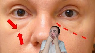 How to treat the under eye Tear THROUGH, Get rid of tear throughs with massage