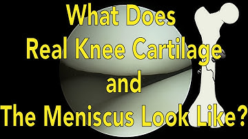 What Does Real Knee Cartilage and the Meniscus Look Like?