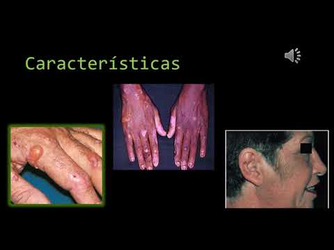 Vídeo: Porfiria Cutánea Tarda: Imágenes, Tratamiento Y Más