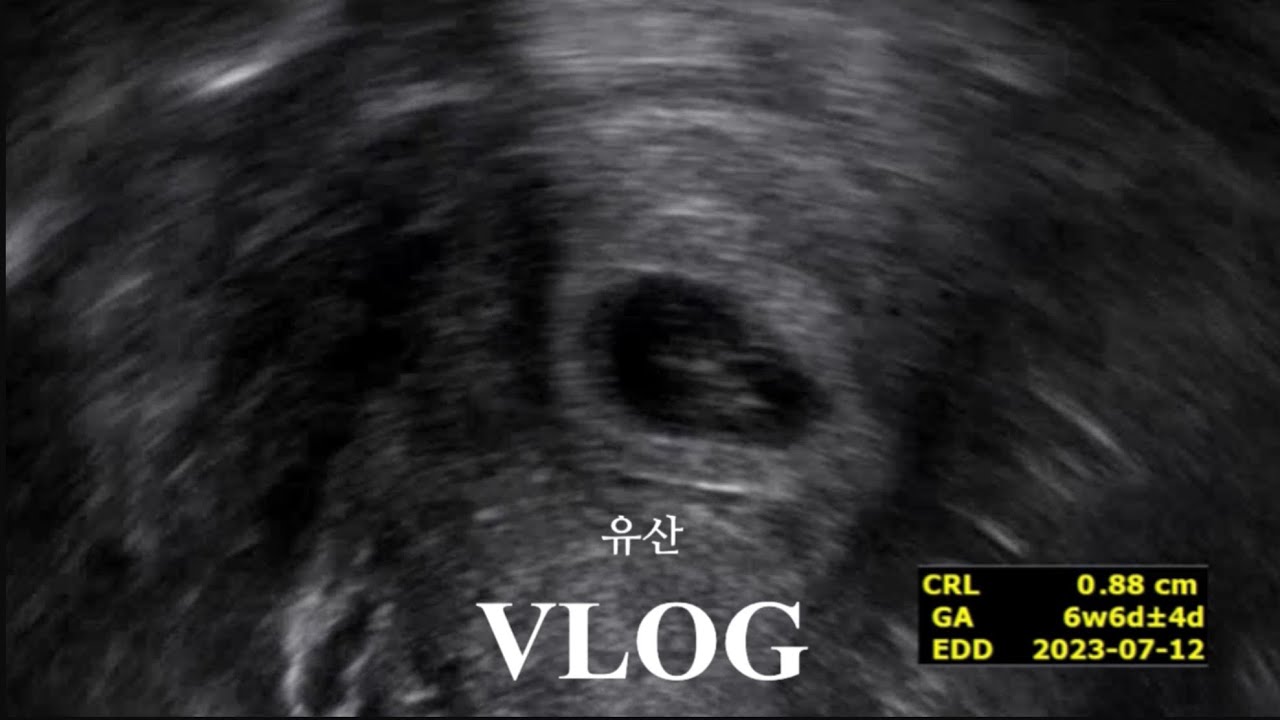 하늘의 별이 된 심장, 9주 심정지 계류유산 자연배출