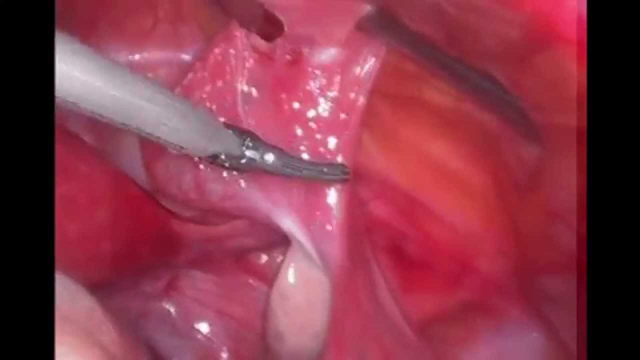 Cisto ovariano / ovarian cyst virgilio liceo