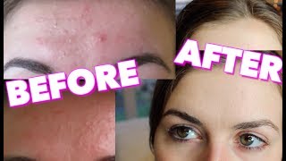 How i cured my forehead acne/ hormonal acne!update:my birth control
ended up being the cause of terrible migraines, so stopped taking
it....