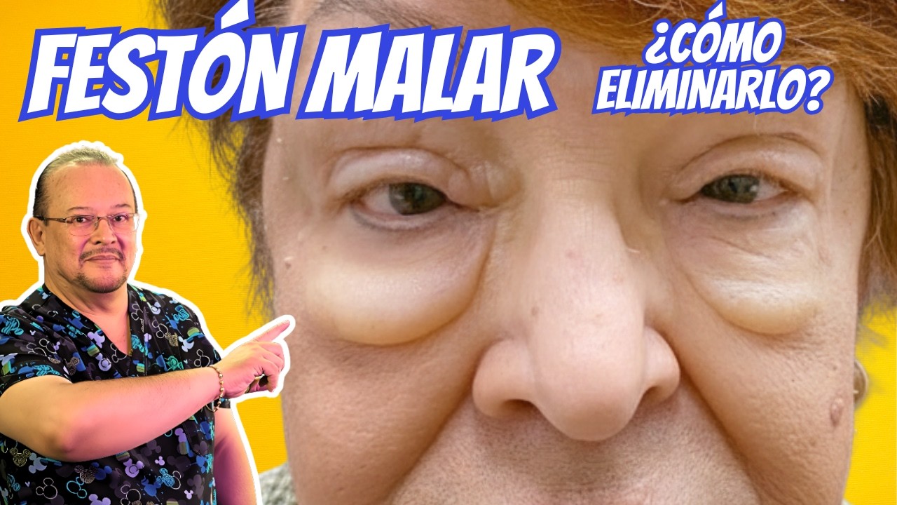 Cómo eliminar la bolsa o Festón Malar