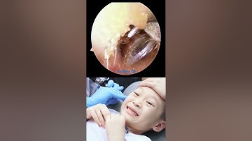 Dị vật ống tai | Bác sĩ Hiệu Long Biên