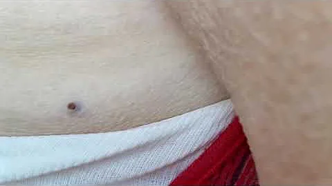 Come eliminare i peli incarniti sul pube?