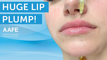 Huge Lip Plump for Young Patient | AAFE