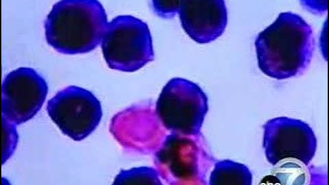 Dr. James Berenson on Treating Multiple Myeloma with Arsenic