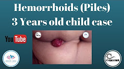 Hemorrhoids (Piles) 3 years old child case 'Rarest of Rare"