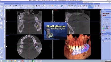 Quick launch 3D volume with impression scans from Planmeca Romexis® to Blue Sky Plan software
