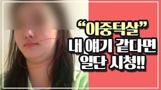 이중턱지방흡입 전 이건 꼭! 반드시!! l 이중턱처짐 l 바이오본드 l 압구정성형외과