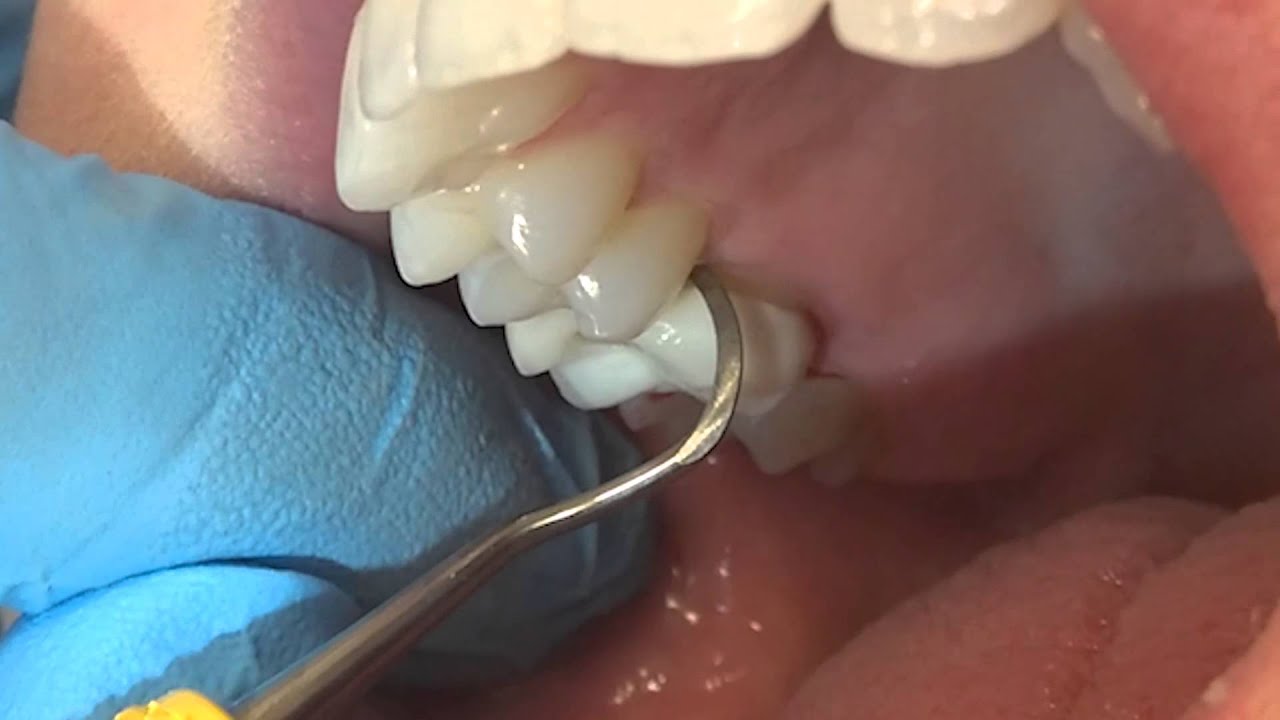 How To Clean A Tooth Crown