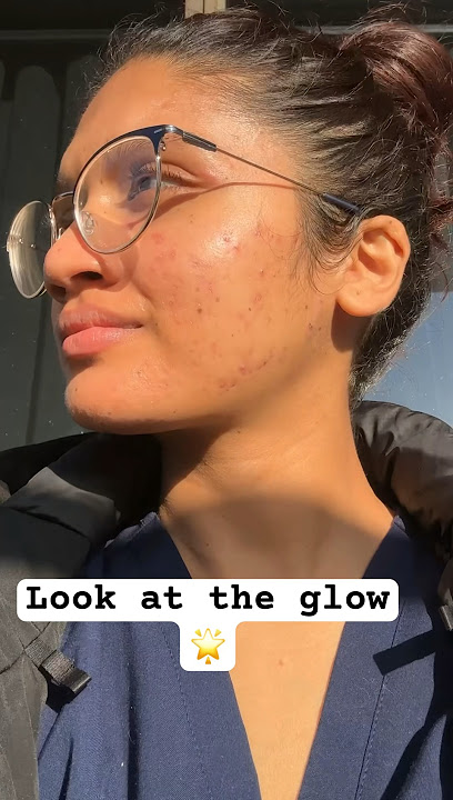 Reapply your sunscreen #acneskin #acneproneskin #sunscreen #acnetreatment #acnepositivity #acnes