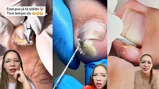 Gross but Satisfying Toenail Extraction 😨